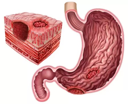 gastrointestinal ülser